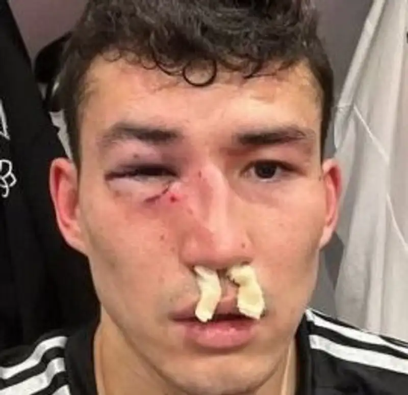 Известный футболист "сошел с ума" после жуткой травмы Зайнутдинова