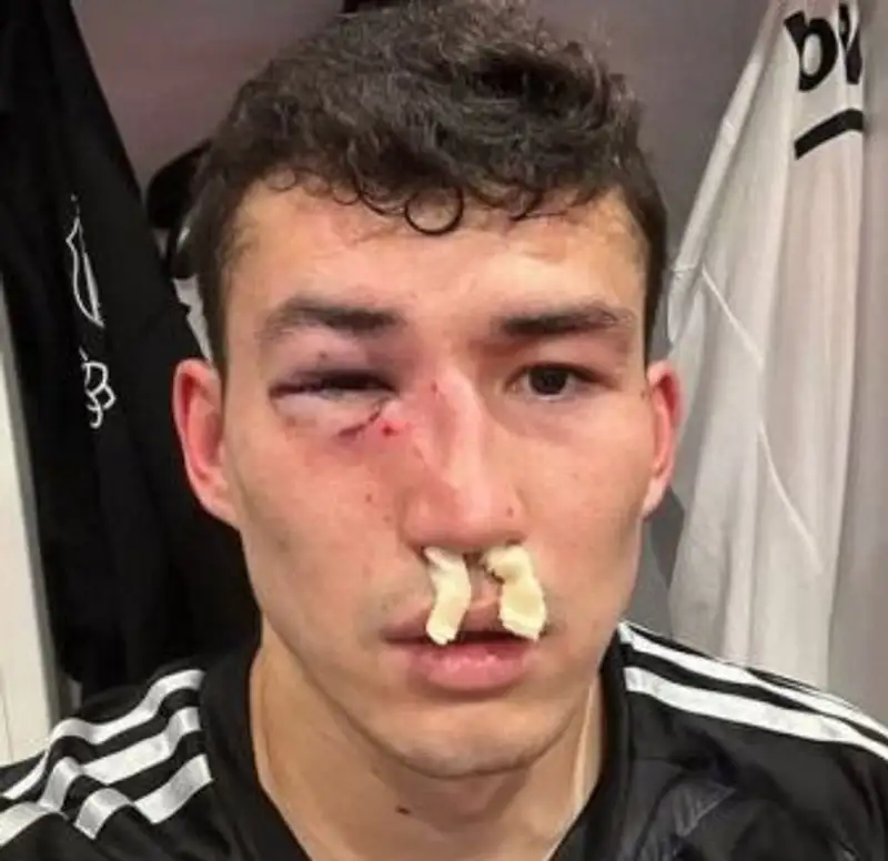 Зайнутдинову разбили лицо в Турции: фото футболиста шокировало болельщиков