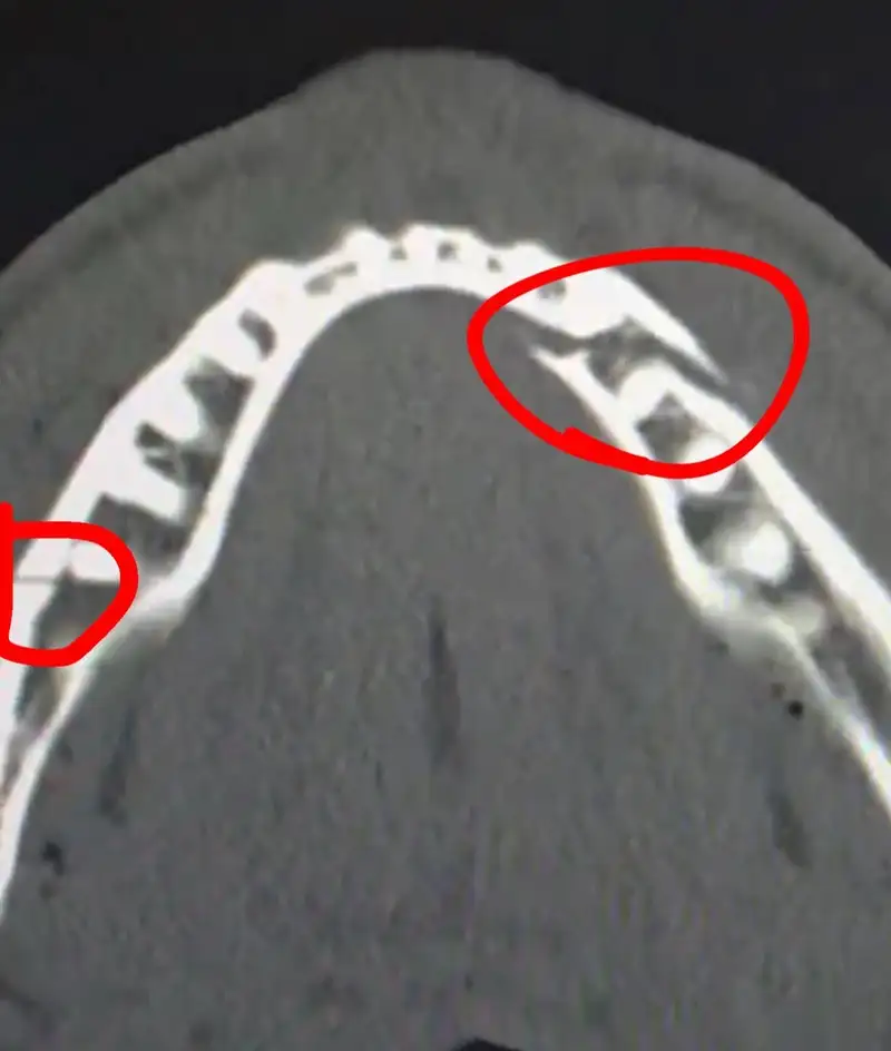 "Дайте "Канело" через 10 дней": Джейк Пол опубликовал снимок сломанной челюсти